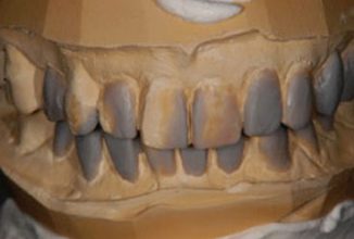 臨床審美歯科 session1