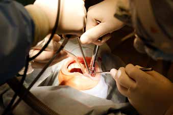 上顎洞の大きな上顎臼歯部にインプラントを埋入する