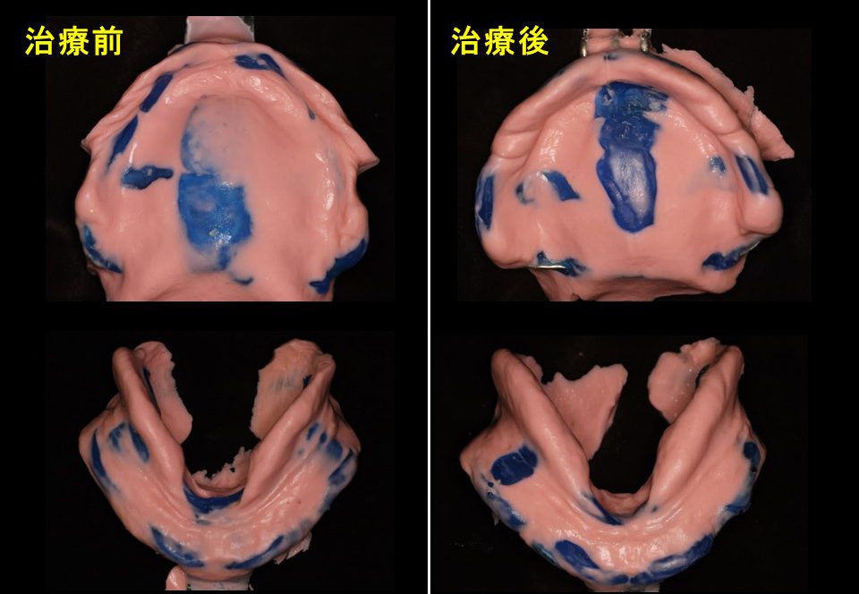 総義歯