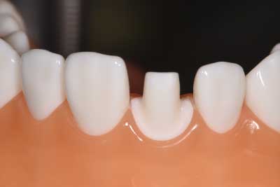 前歯の形成　CADCAM冠　３ 、 １