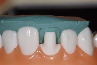 前歯の形成　CADCAM冠　３ 、 １