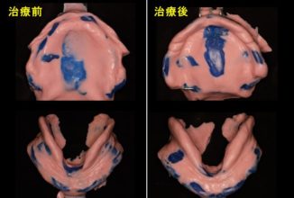 全部床義歯補綴臨床の基本マスター