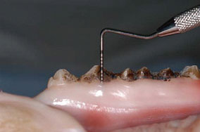 歯周基本治療（歯周治療II）