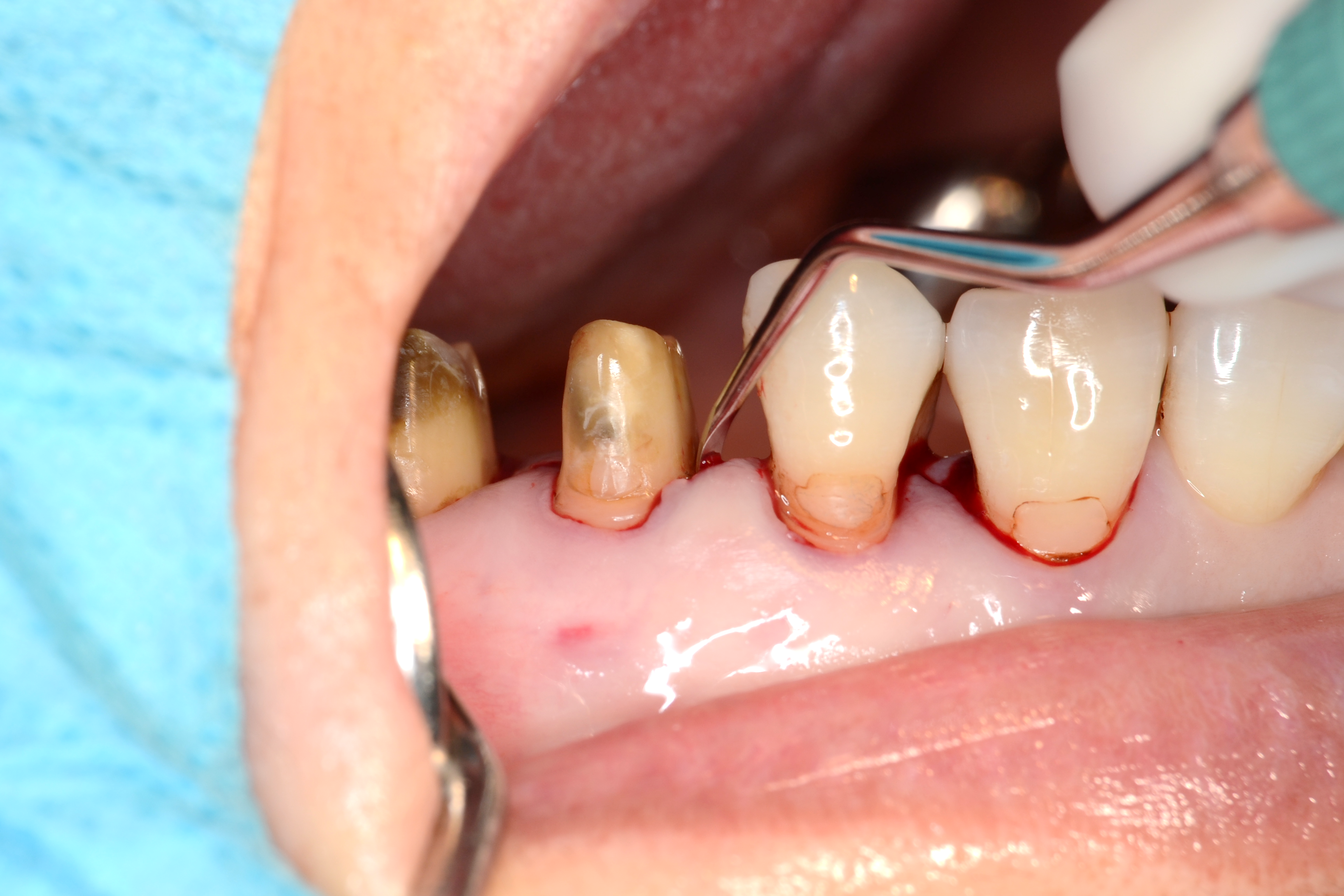 アドバンスコース（歯周治療）歯周組織再生療法01