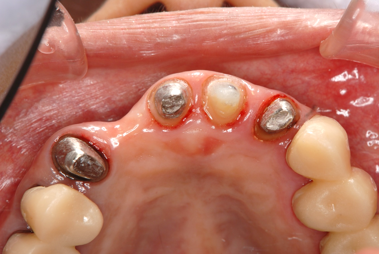 アドバンスコース（歯周治療）ソフトティッシュマネジメント01