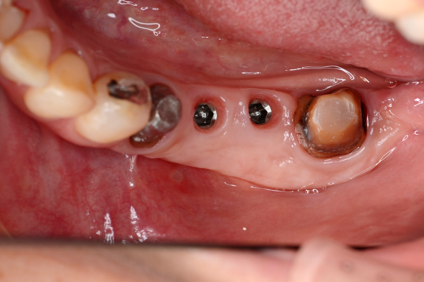 アドバンスコース（歯周治療）ソフトティッシュマネジメント04