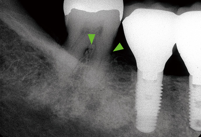 アドバンスコース（歯周治療）歯周組織再生療法04