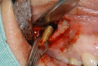 インプラント手術トラブルを回避・解決する