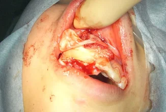 インプラント希望だが骨が少ない症例が来院した