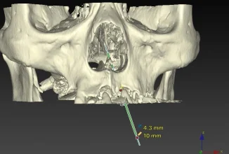 アナログで始めるフルアーチ即時荷重インプラント