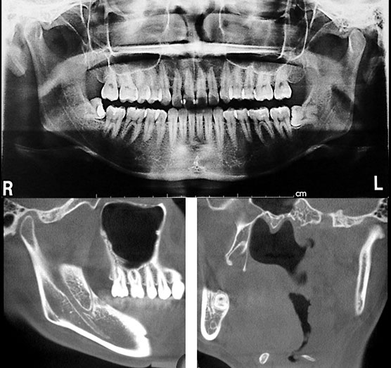 デモンストレーション 小外科手術（埋伏抜歯）龍田先生