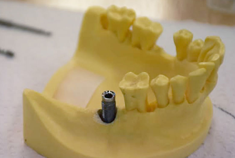 ibs インプラント二次手術2