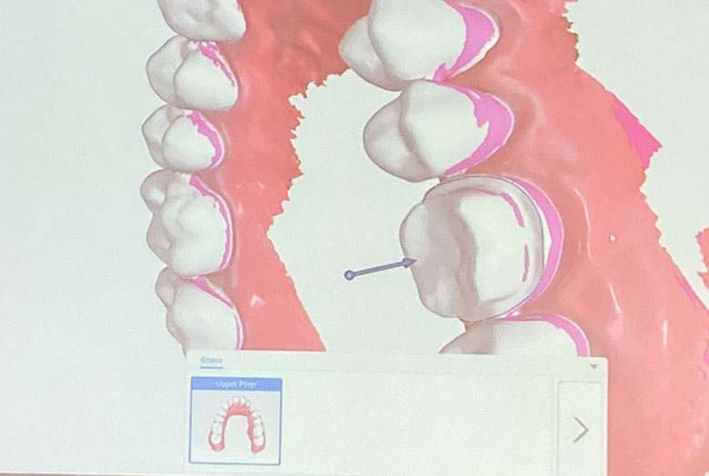 デモンストレーション 審美修復の理論と実際 貞光先生