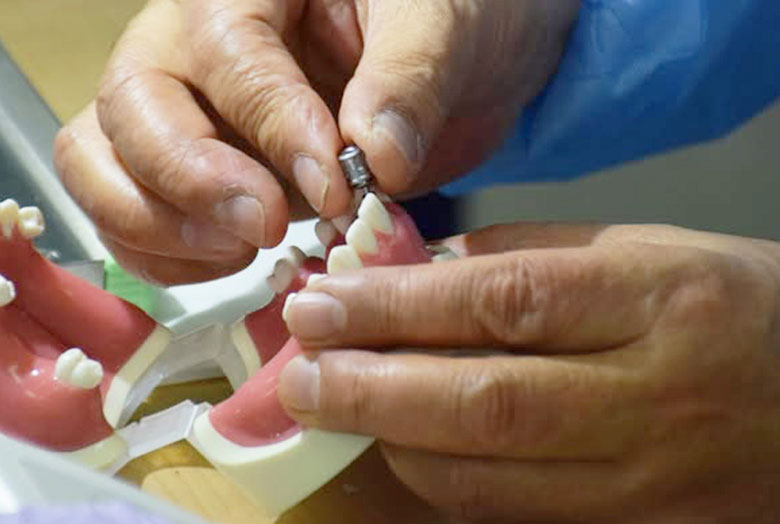 impad_審美的インプラント修復のために