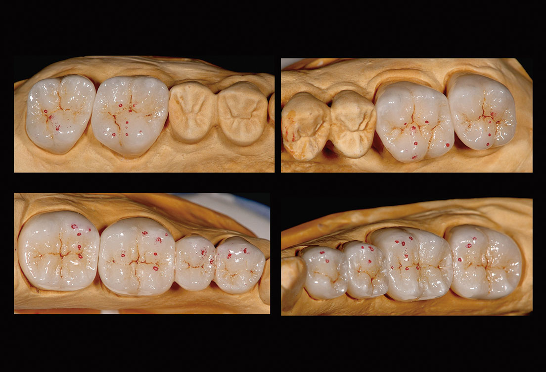 オーラルリハ クロスマウントテクニック